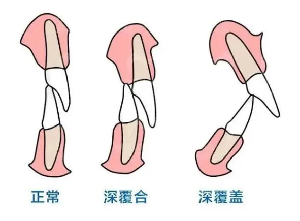 深覆合