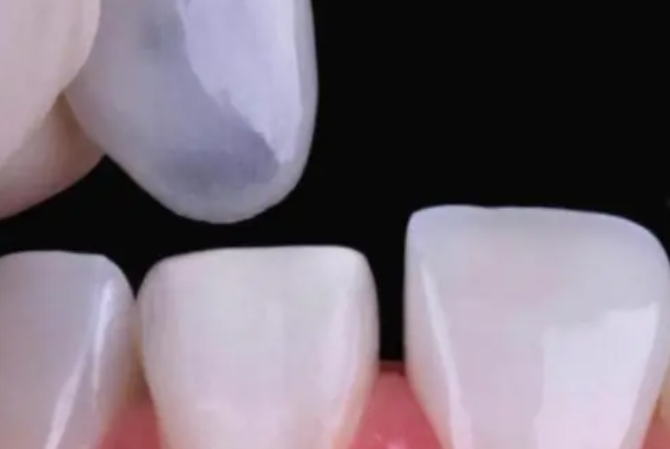 溫州牙貼面口腔醫院排名榜-溫州佳潔口腔牙貼面尤其好價(jià)格2000起