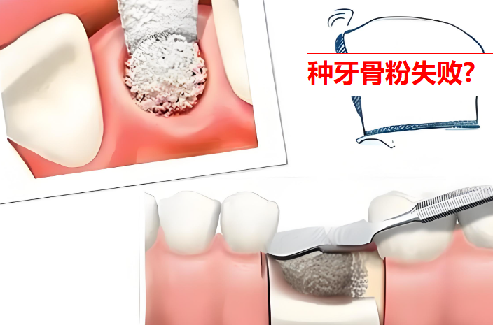 種牙骨粉價(jià)格那么貴,骨粉失敗掉出來(lái)怎么辦?知道征兆早預(yù)防省老多錢(qián)了