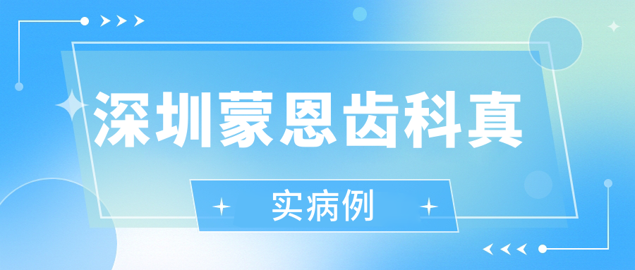 深圳蒙恩齒科真實(shí)病例