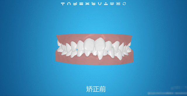 牙齒矯正